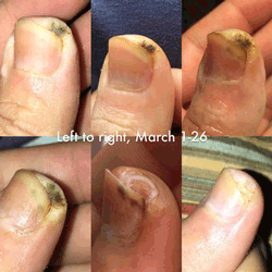 wart stages