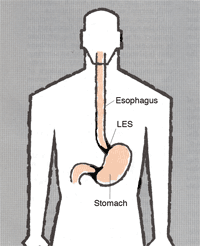 vinegar and acid reflux