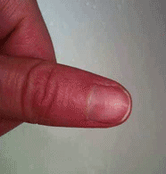 VerrueOngleDuPouceDisparueApresTraitementDesVerruesVinaigreCidreDePomme