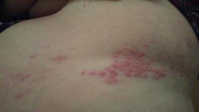 Du vinaigre de cidre de pomme pour le zona