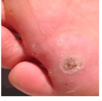 Plantar wart: Day12
