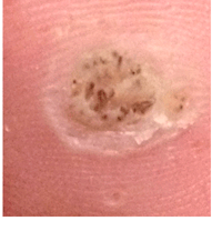 Plantar wart: Day12