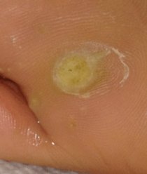 Plantar wart: Day1, 12pm