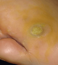 Plantar wart: Day1, 2pm