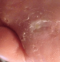 Plantar wart: Day28a