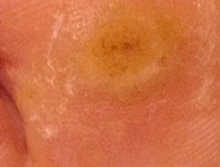 Plantar wart: Day3