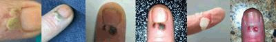 finger wart finger wart